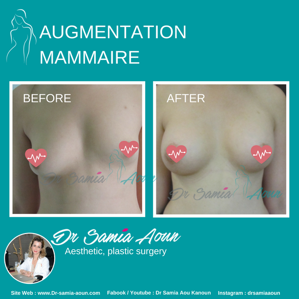 augmentation-mammaire2