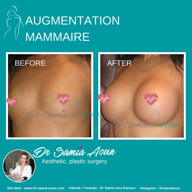 augmentation-mammaire4