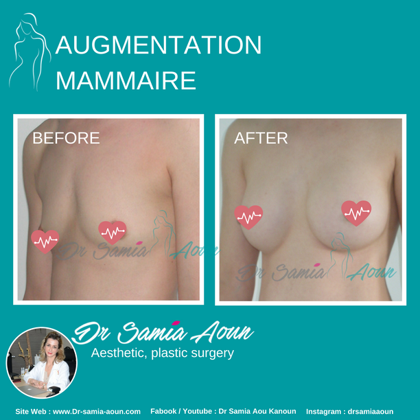 augmentation-mammaire1