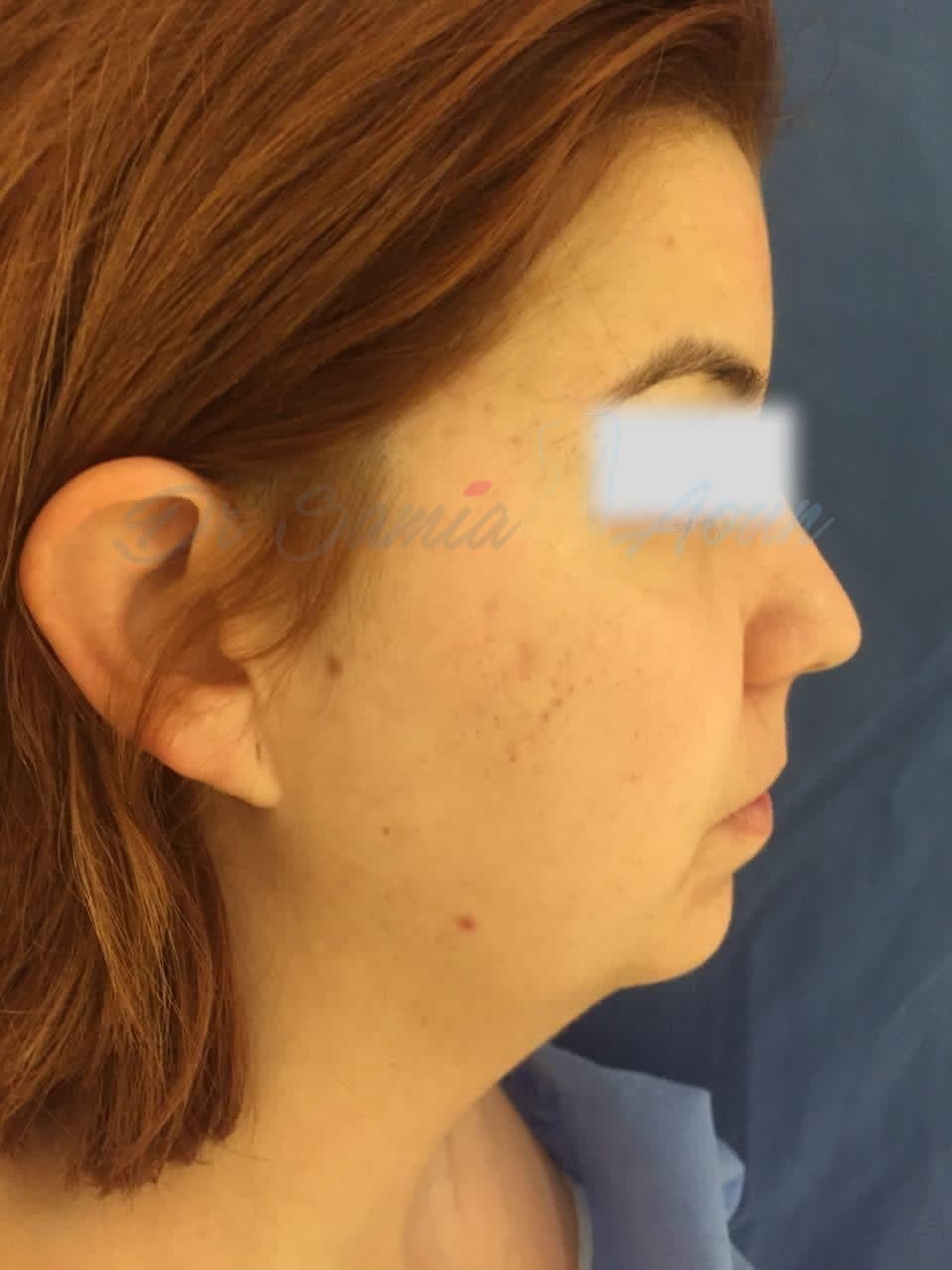 Génioplastie d'avancement — AVANT