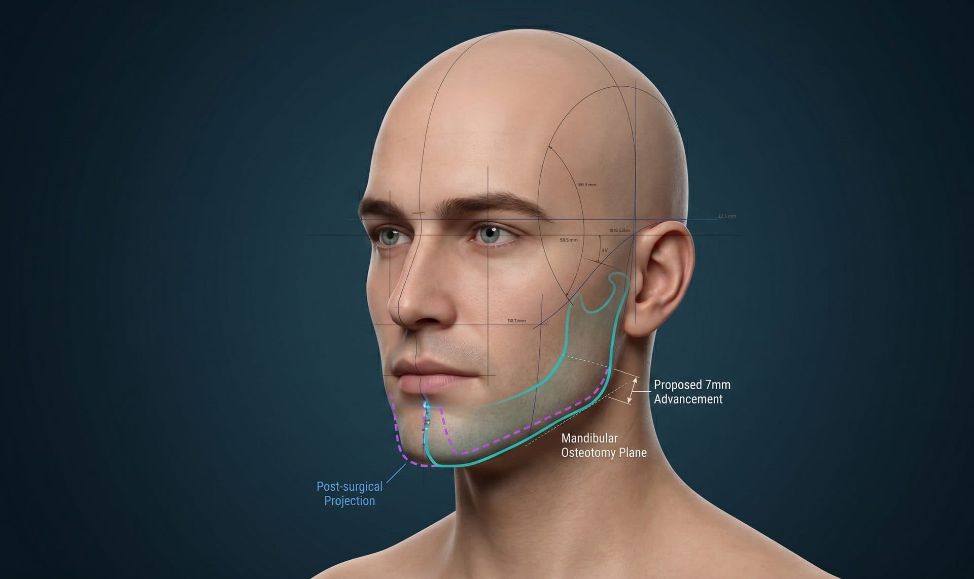 Profiloplastie : La Vision Globale