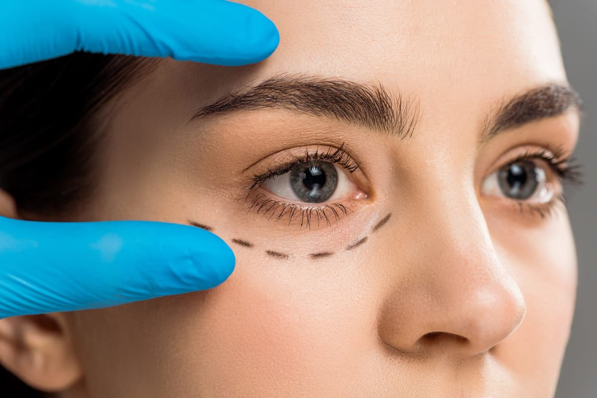 B/ Blépharoplastie inférieure