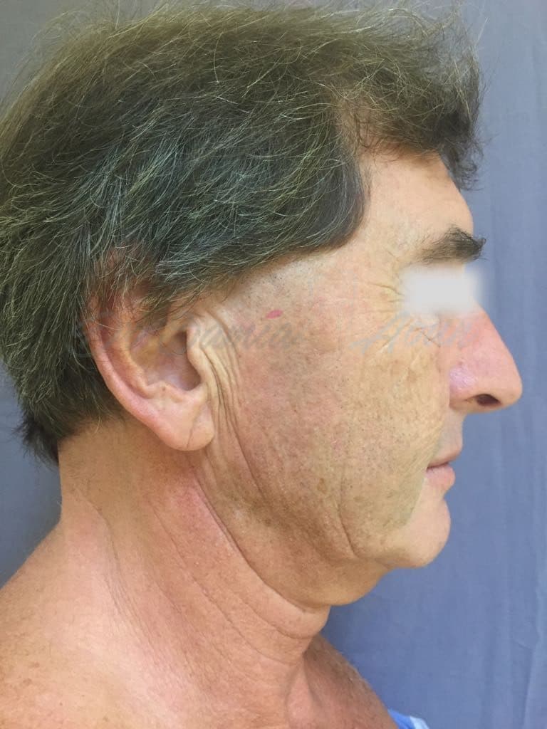Lifting Cervico-facial & SMAS — APRÈS