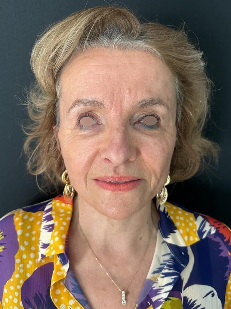 Lifting Cervico-facial — APRÈS