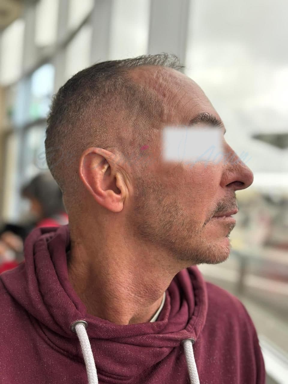 Lifting Cervico-facial — APRÈS