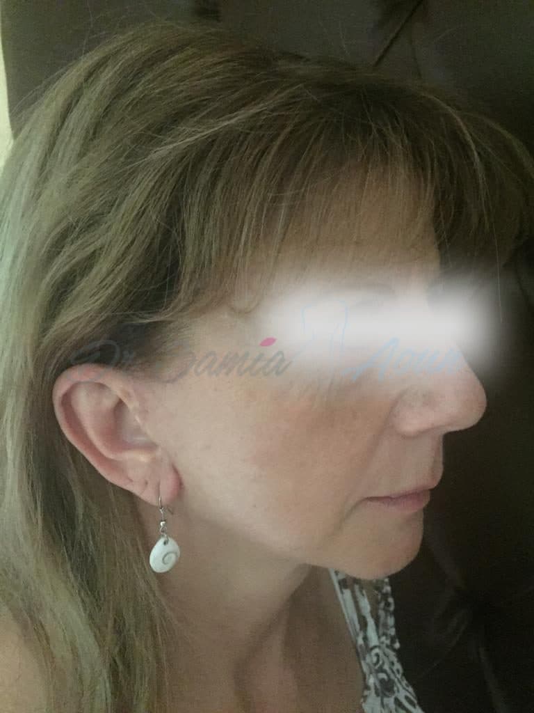 Lifting Cervico-facial — APRÈS
