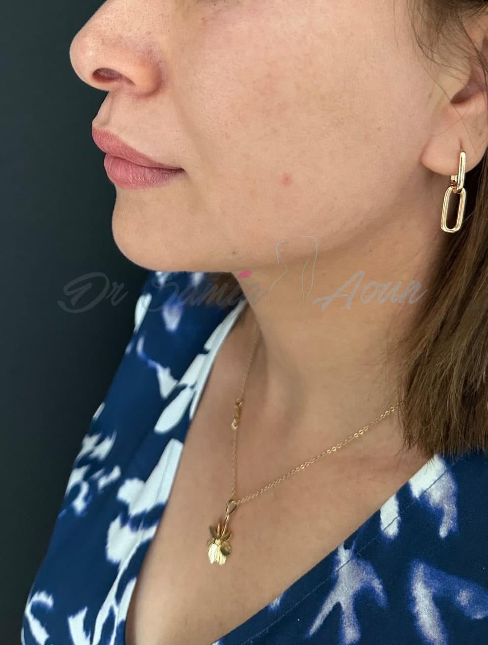 Lifting Cervico-facial — APRÈS