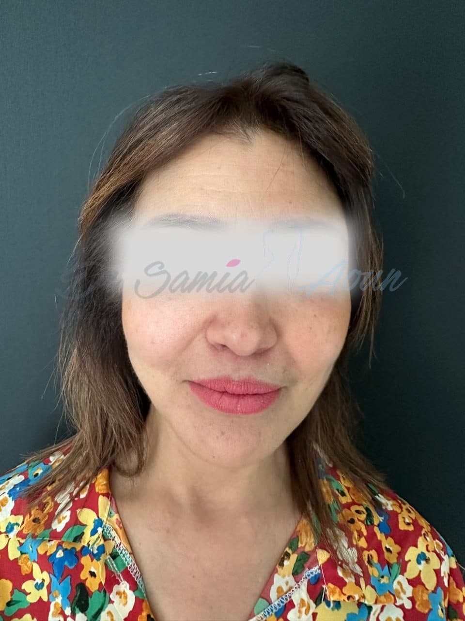Lifting Cervico-facial — APRÈS