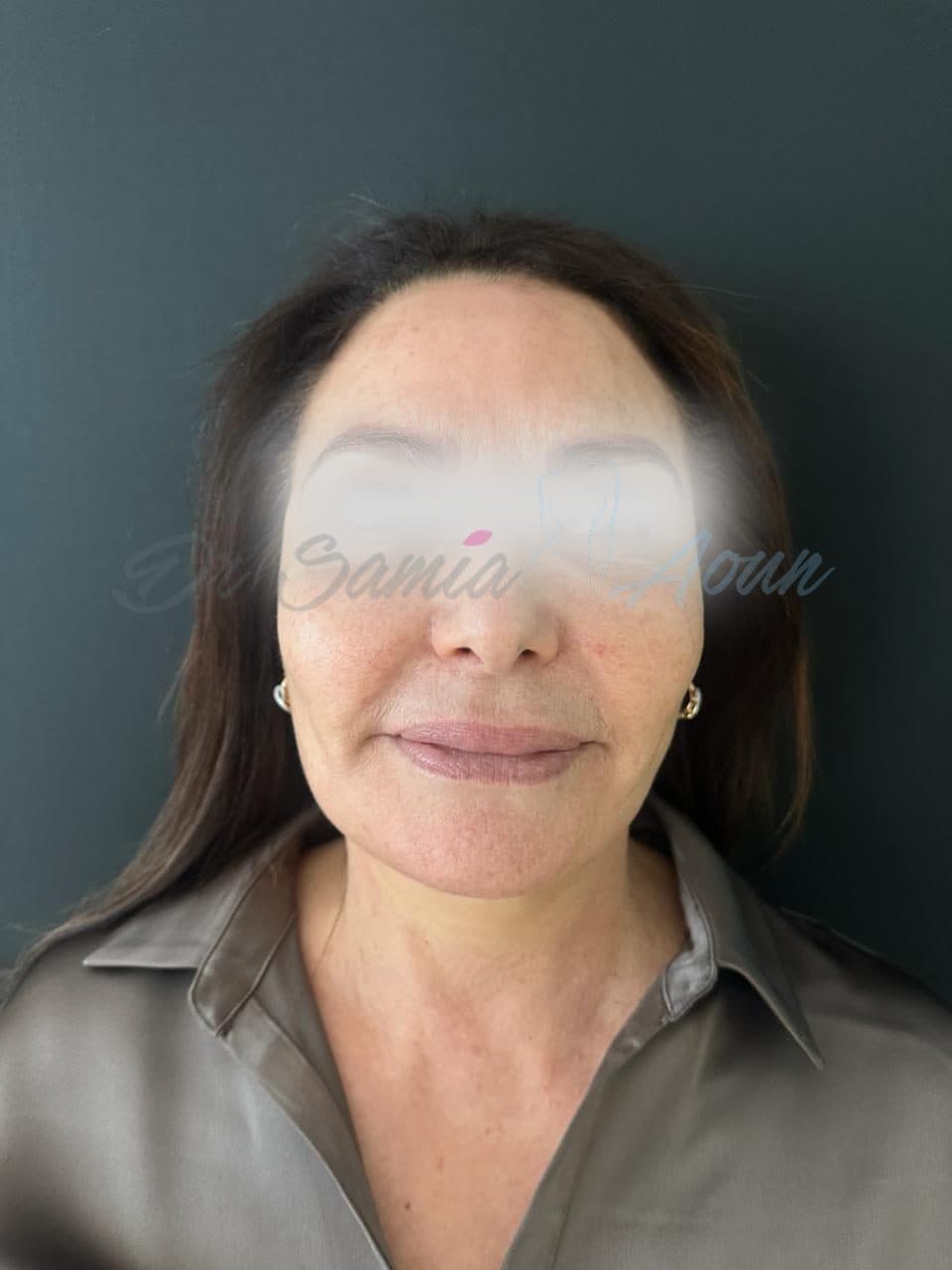 Lifting Cervico-facial — APRÈS