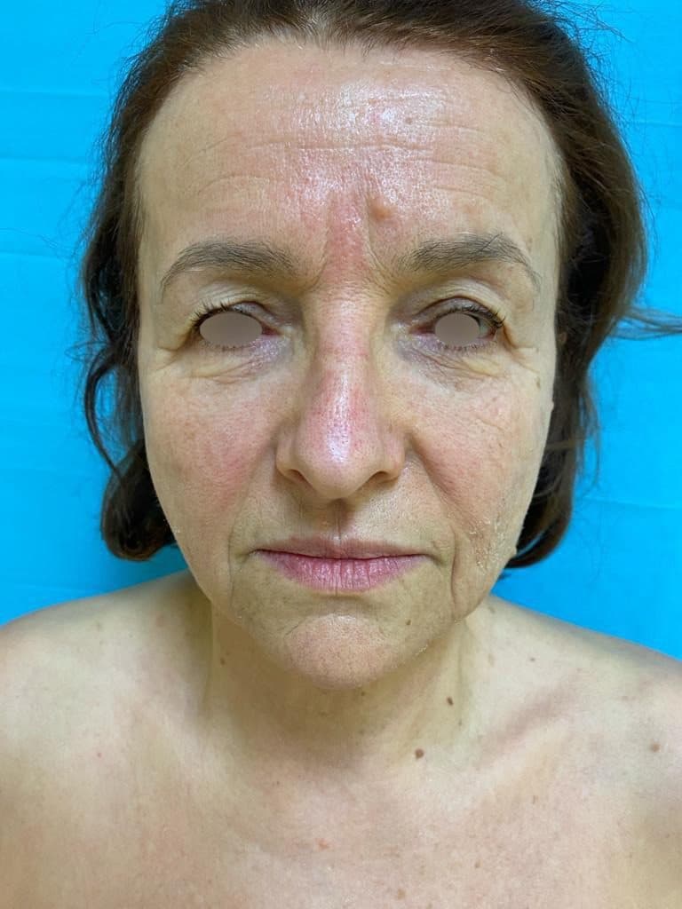 Lifting Cervico-facial — AVANT