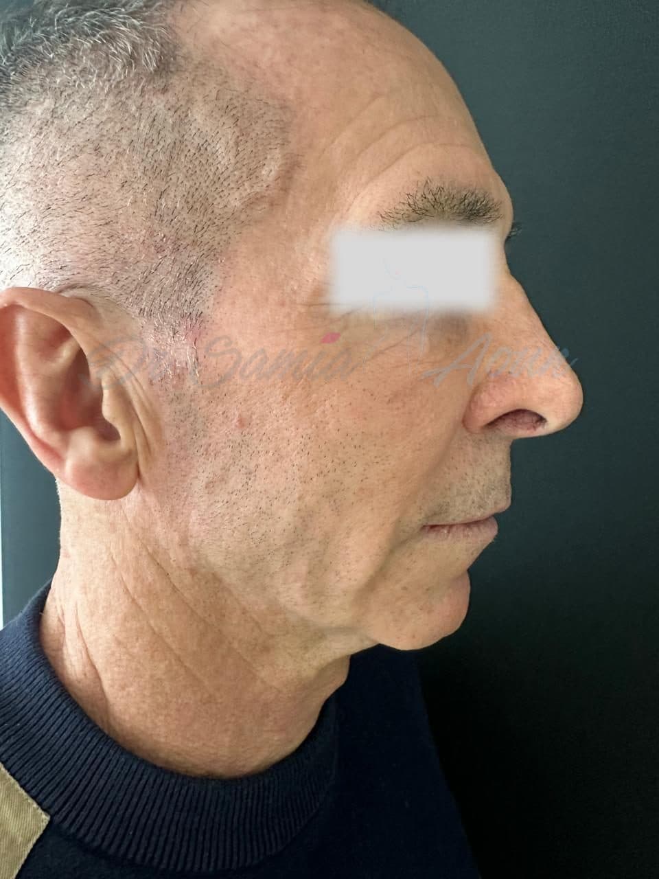 Lifting Cervico-facial — AVANT