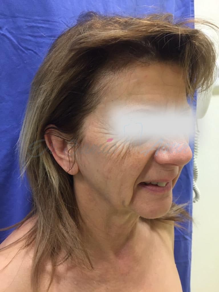Lifting Cervico-facial — AVANT