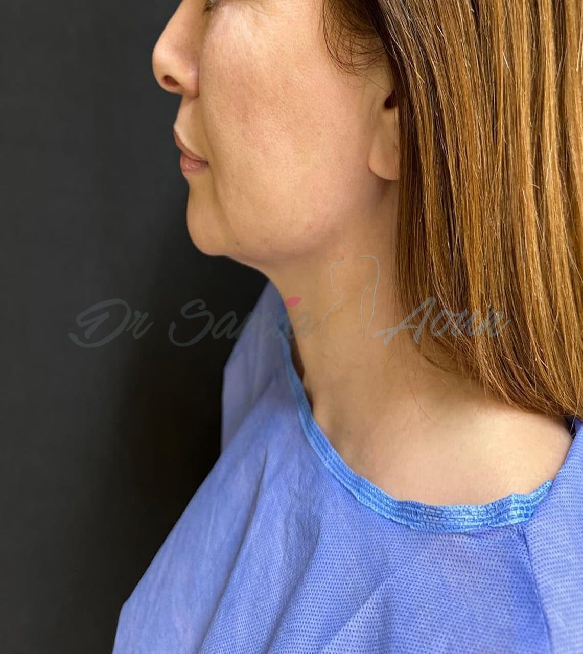 Lifting Cervico-facial — AVANT