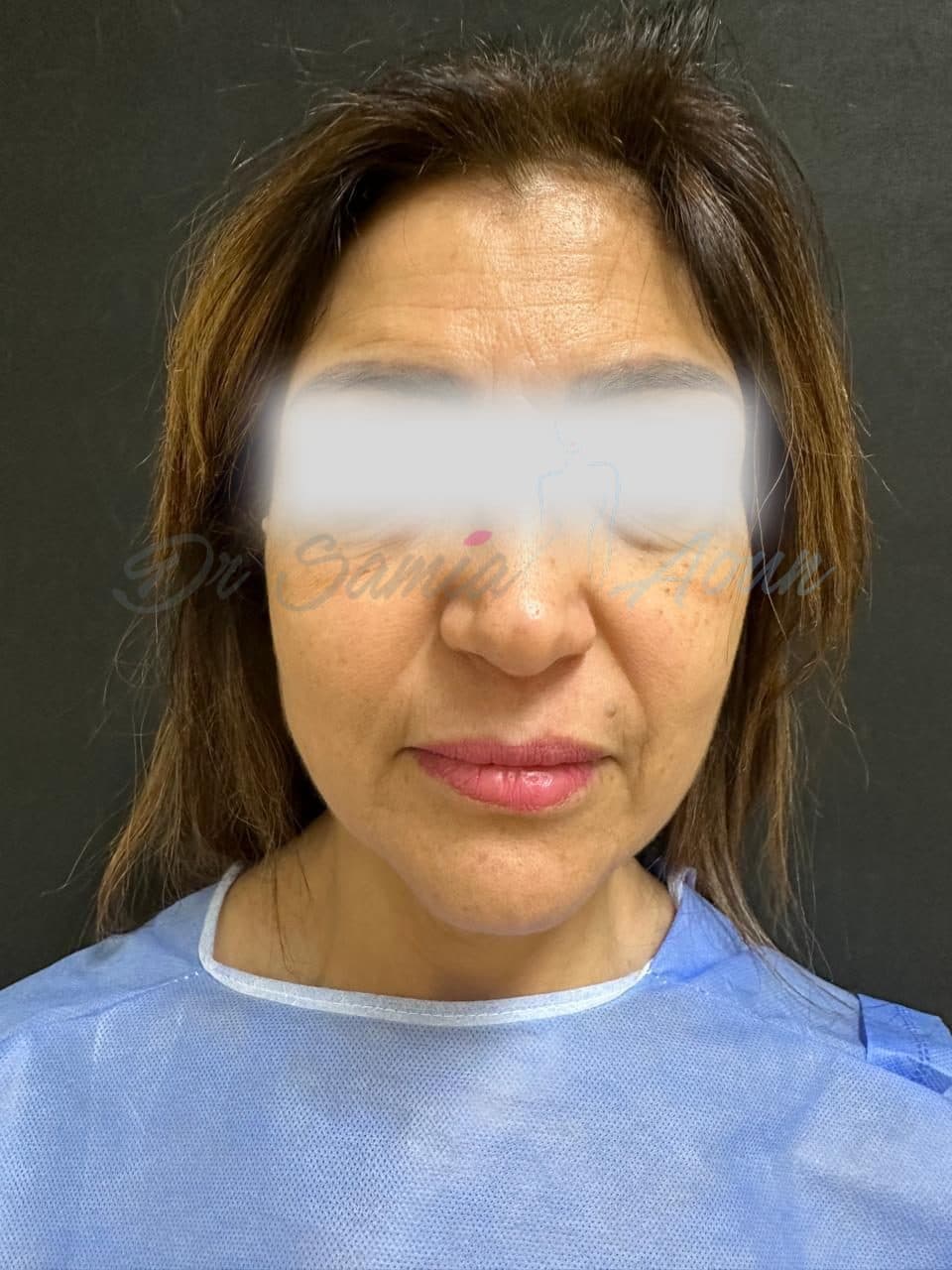 Lifting Cervico-facial — AVANT