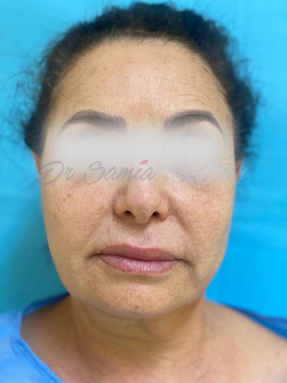 Lifting Cervico-facial — AVANT