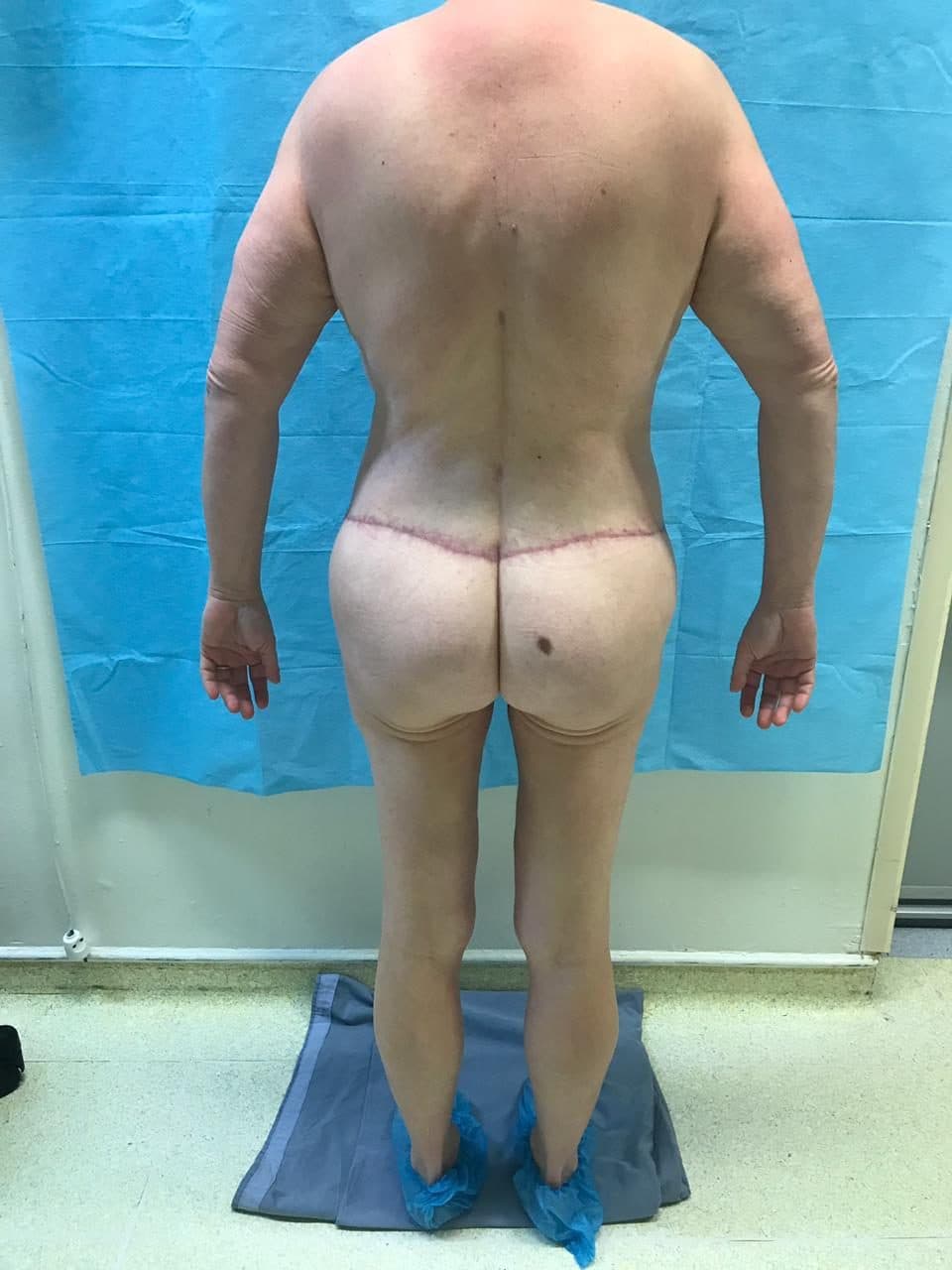 BBL & Liposculpture 360