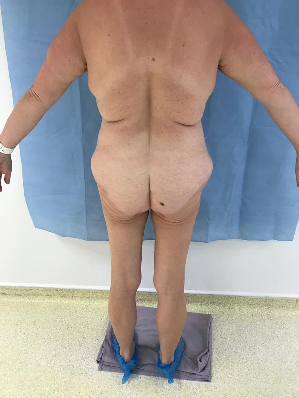 BBL & Liposculpture 360