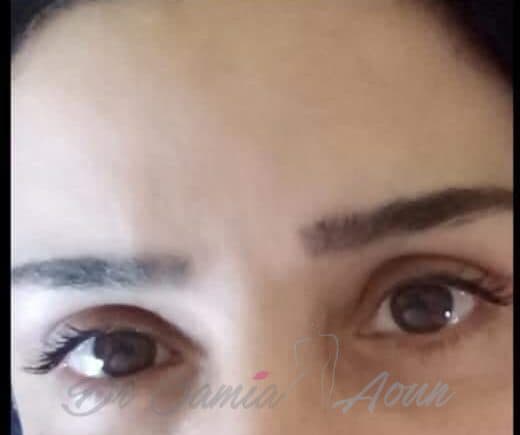 Blépharoplastie 4 Paupières