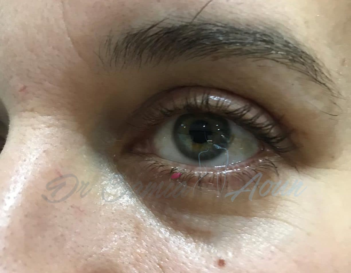 Blépharoplastie Inférieure