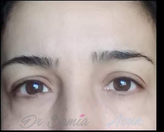 Blépharoplastie 4 Paupières