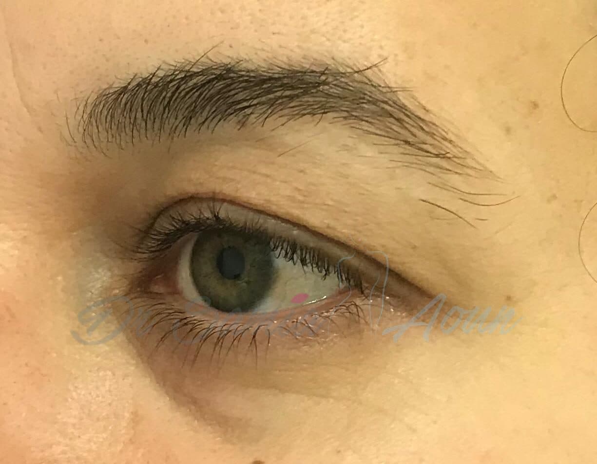 Blépharoplastie Inférieure