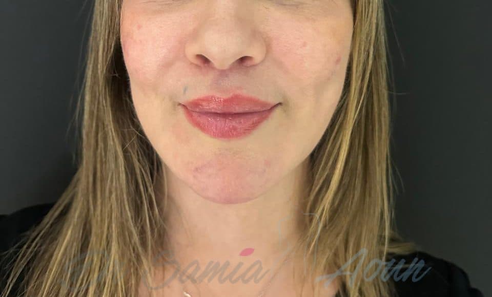 Patient A - 42 ans