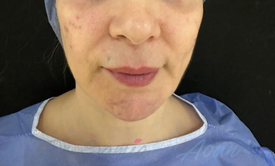 Patient A - 42 ans