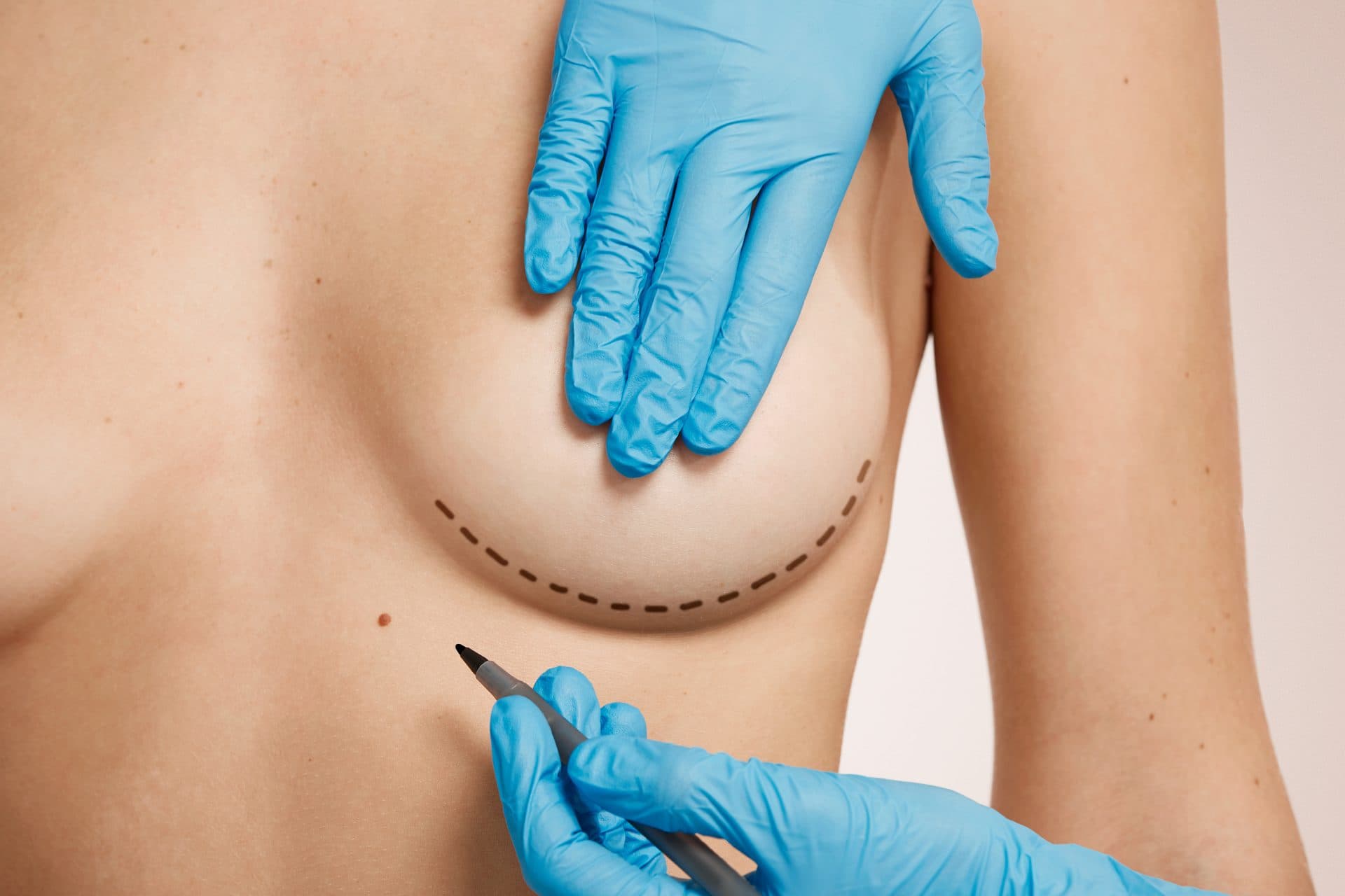 Lipofilling – Approche naturelle, indication réfléchie
